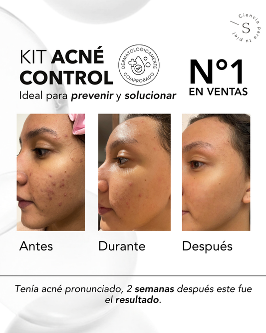 KIT ACNE CONTROL