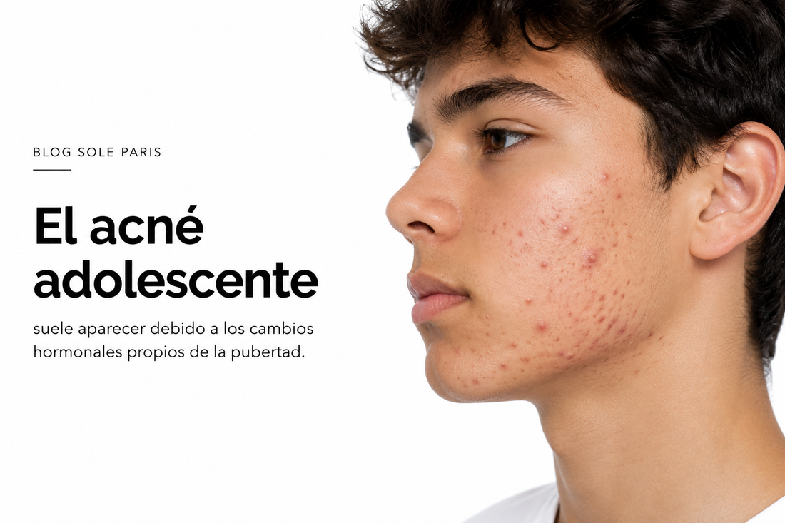 Acné adolescente: tratamiento natural para una piel más saludable