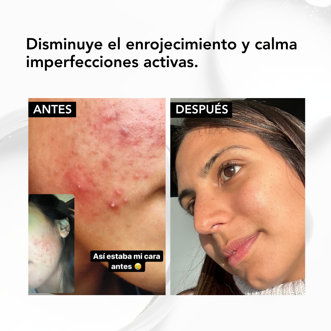 ✨ NIACINAMIDA B3: serum Acné Control -seborregulador
