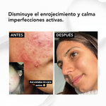 ✨ NIACINAMIDA B3: serum Acné Control -seborregulador