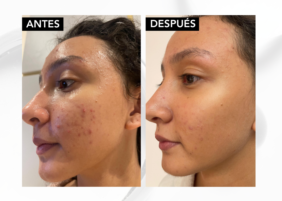 ✨ NIACINAMIDA B3: serum Acné Control -seborregulador