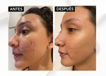 ✨ NIACINAMIDA B3: serum Acné Control -seborregulador