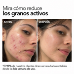 KIT ACNÉ SOS