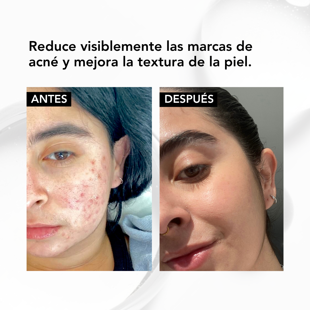 ✨ NIACINAMIDA B3: serum Acné Control -seborregulador