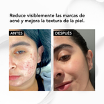 ✨ NIACINAMIDA B3: serum Acné Control -seborregulador