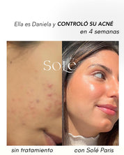 KIT ACNE CONTROL