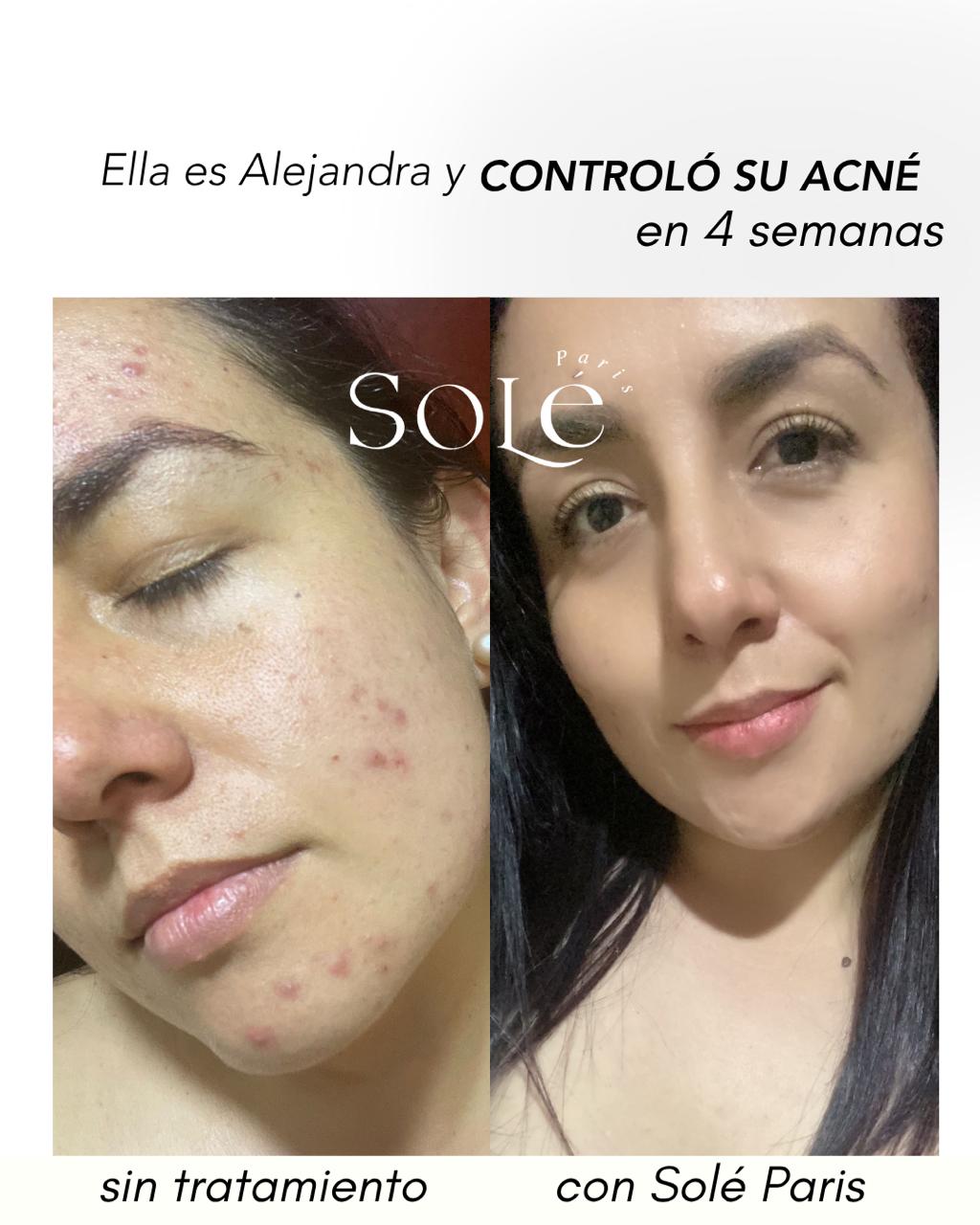 KIT ACNE CONTROL