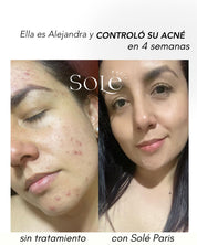 KIT ACNE CONTROL
