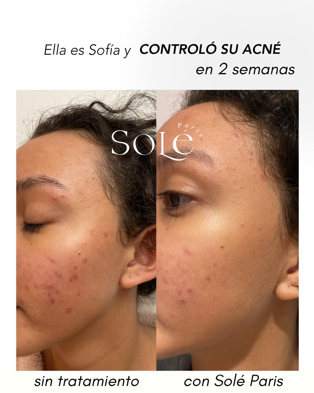 KIT ACNE CONTROL