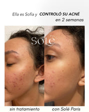 KIT ACNE CONTROL